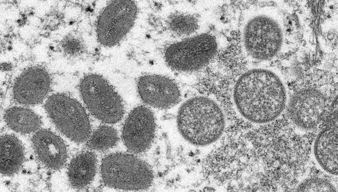 Canada says 15 examples of monkeypox in Quebec, more expected